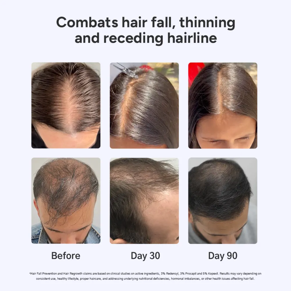 Grow Strong Kit | Super Shampoo (150ml) + Hair Growth Serum (30ml) + Derma Roller - Image 5